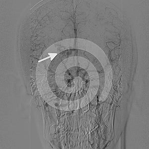 Intracranial vascular malformation