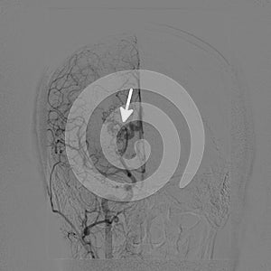 Intracranial vascular malformation photo