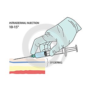 Intradermal injection. Effective methods of administration of drugs and other medical solutions that are used.