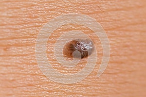 Intradermal nevus photo