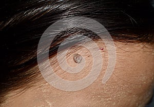 Intradermal nevus or single mole at the forehead of Southeast Asian, Myanmar young woman photo
