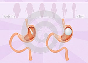 Intragastric balloon