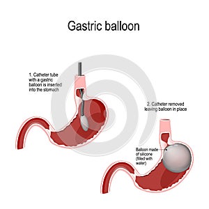 Intragastric Balloon. Gastric Balloon Inside a Stomach