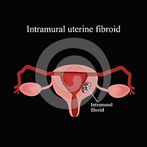 Intramural fibroids. Endometriosis. Infographics. Vector illustration on a black background