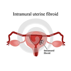 Intramural uterine fibroids. Endometriosis. Infographics. Vector illustration on white background