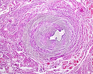 Intramural uterine tube