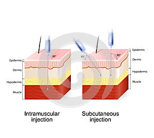 Intramuscular injection and Subcutaneous injection photo