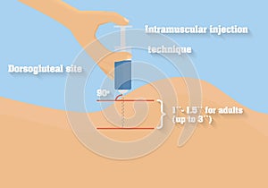 Intramuscular injection technique vector illustration. Technique of intramuscular route of administration