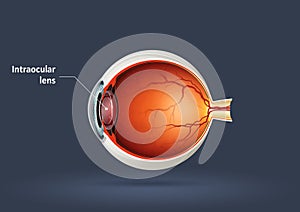 Intraocular lens photo