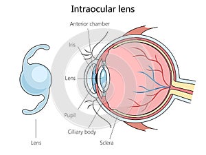 Intraocular lens structure diagram medical science