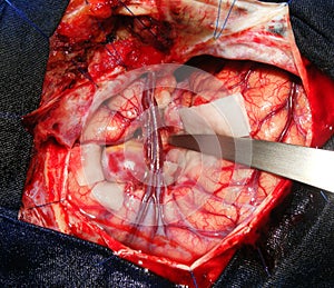 Brain surgery for a giant aneurysm photo