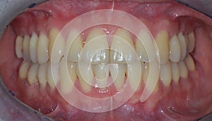 Intraoral photo after braces removal