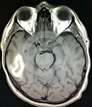 Intraparenchymal hematoma brain pathology mri photo