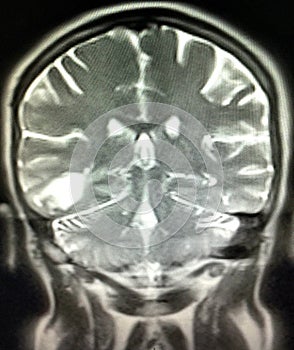 Intraparenchymal hematoma brain pathology mri photo