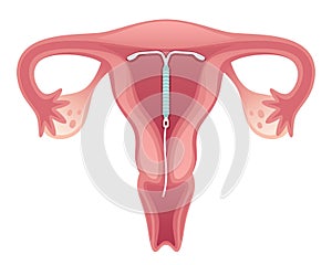 Intrauterine device