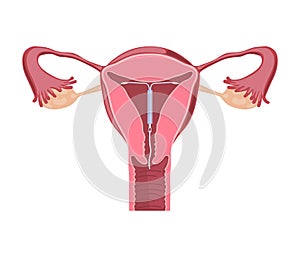 Intrauterine Device. Contraceptives Method