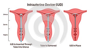 Intrauterine device. IUD placement in uterus. Female contraception