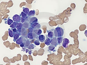 Intravascular lymphoma in bone marrow. photo