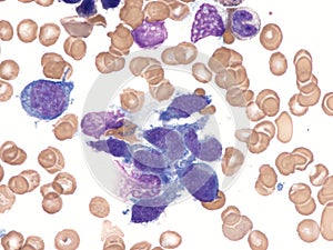 Intravascular lymphoma. Bone marrow. photo