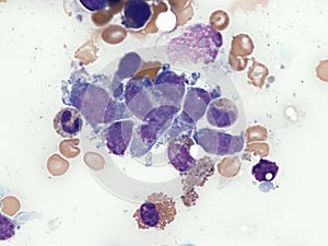 Intravascular lymphoma. Bone marrow. photo