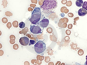 Intravascular lymphoma in bone marrow. photo