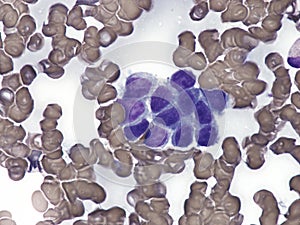 Intravascular lymphoma in bone marrow. photo