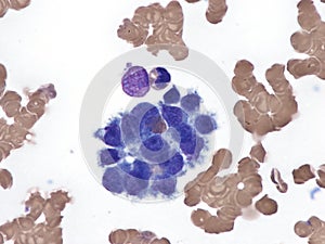 Intravascular lymphoma in bone marrow. photo