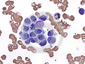 Intravascular lymphoma in bone marrow. photo
