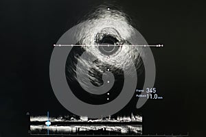 Intravascular ultrasound imaging IVUS