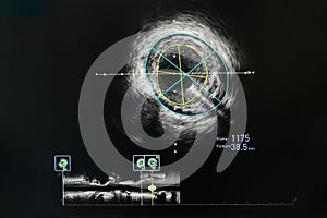 Intravascular ultrasound imaging IVUS