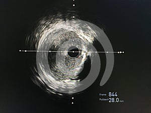 Intravascular ultrasound imaging IVUS