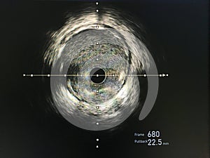 Intravascular ultrasound imaging IVUS