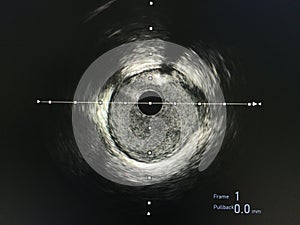 Intravascular ultrasound imaging IVUS