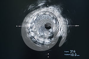 Intravascular ultrasound imaging IVUS