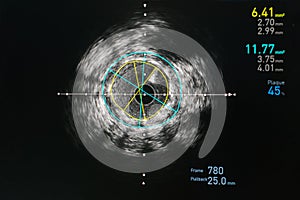 Intravascular ultrasound imaging IVUS