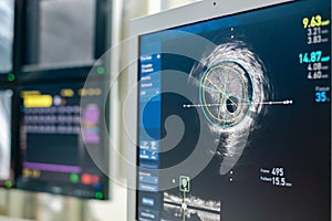 Intravascular ultrasound imaging IVUS