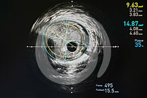 Intravascular ultrasound imaging IVUS