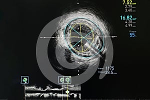 Intravascular ultrasound imaging IVUS photo