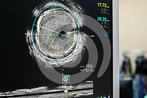 Intravascular ultrasound imaging IVUS photo