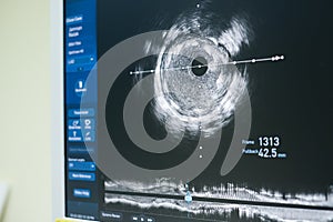 Intravascular ultrasound imaging IVUS photo