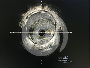 Intravascular ultrasound imaging IVUS photo