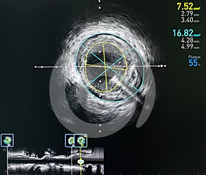 Intravascular ultrasound imaging IVUS . equipment and medical in operating room.