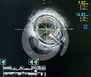 Intravascular ultrasound imaging IVUS . equipment and medical in operating room. photo