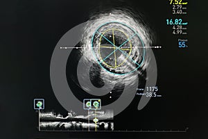 Intravascular ultrasound imaging IVUS photo