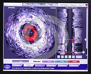 Intravascular ultrasound study.