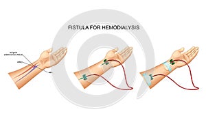Intravenous catheter, hemodialysis and fistula photo