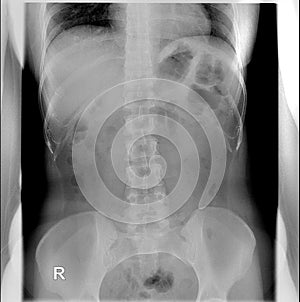 Intravenous pyelogram. Supine position. Intestinal gas partially overlying renal shadows... photo