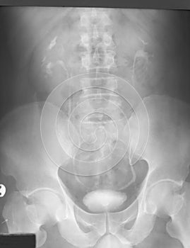 Intravenous pyelography (IVP), 10 minutes after urographin injection film, of a 41 years old man, demonstrated enlarge both kidney