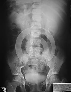 Intravenous pyelography (IVP), 20 minutes after urographin injection film, of a 21 years old woman, demonstrated unremarkable stud photo