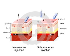 Intravenous therapy and Subcutaneous injection.